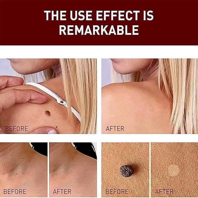 Tags and Moles Remover